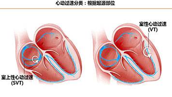 什么是心动过速