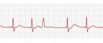 The disadvantages of catheter ablation are greater in these AF patients